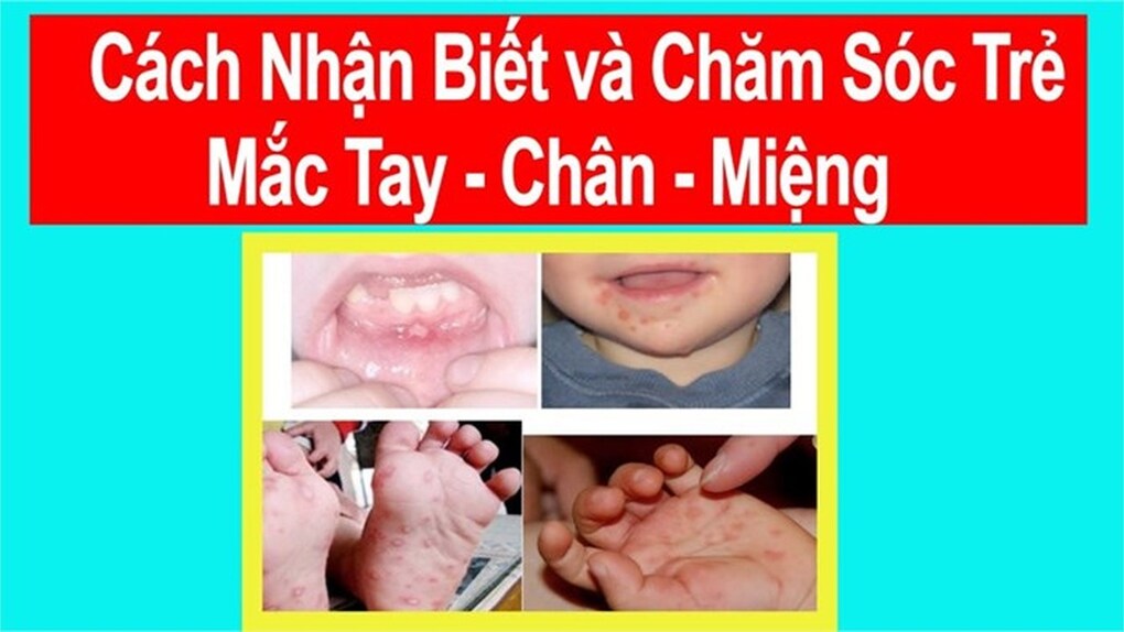 Phòng, chống bệnh tay - chân - miệng ở trẻ em
