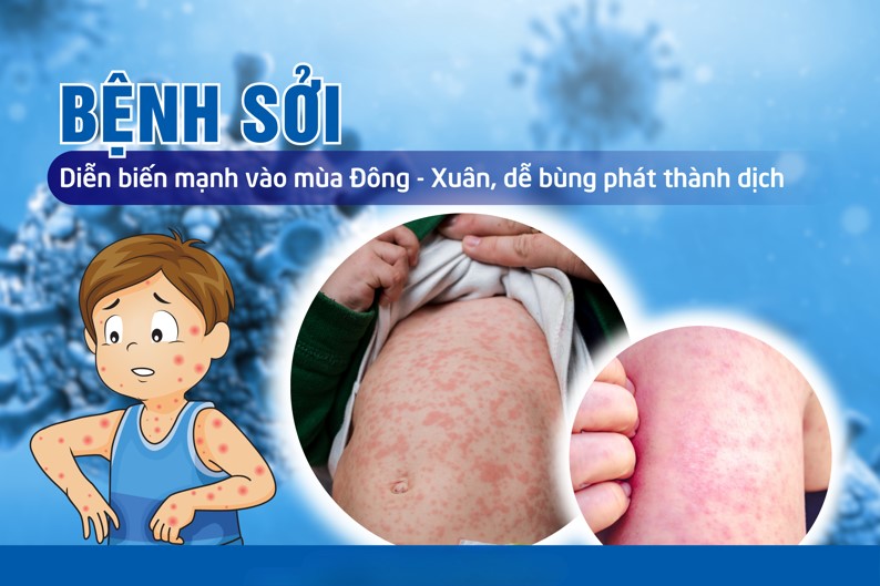 Bệnh Sởi và cách phòng tránh
